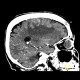 Hemorrhage in brain metastasis, perifocal edema - follow-up after 6 months: CT - Computed tomography